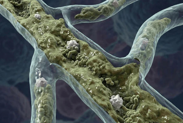 Buildup inside lymphatic vessels